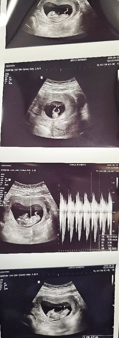 11주차 초음파 사진 성별 봐주실분...ㅎㅎ