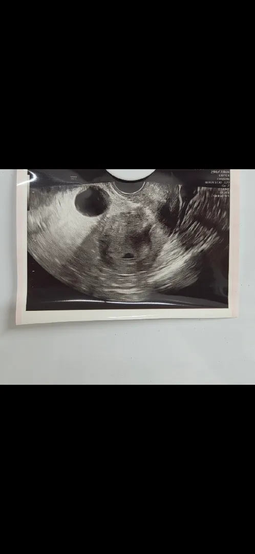 아기집이 작대요 ㅠ 괜찮겠죠?