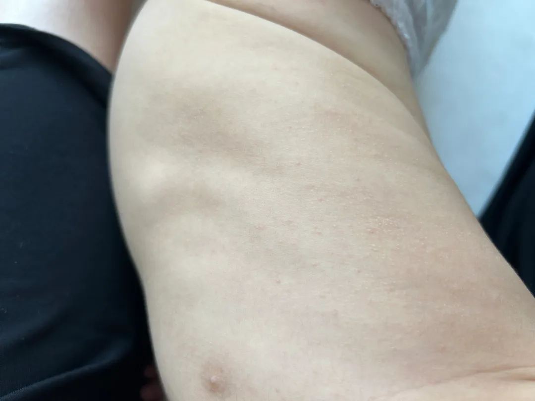 아기 땀띠 일까요??