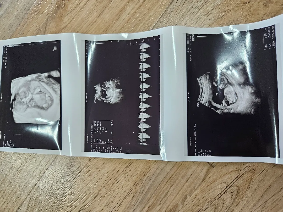 12주 4일 성별봐주세요