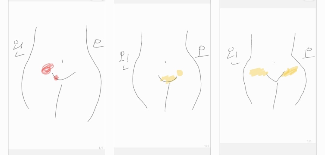 임신 초기에.. 이 사진처럼 통증이 있나요?(나팔관, 자궁)