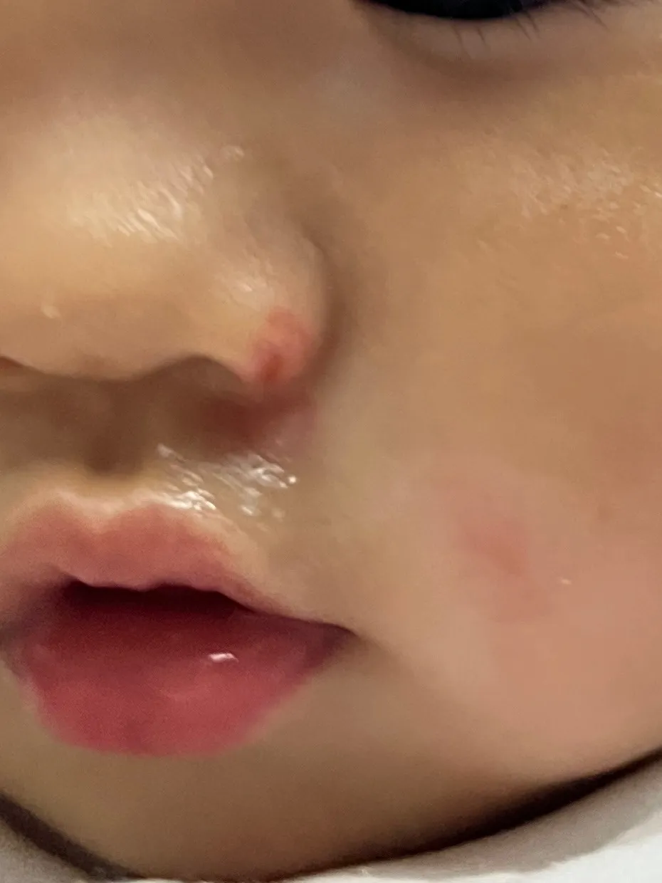아기 얼굴 상처 연고 흉터 연고 추천해주세요ㅠㅠ