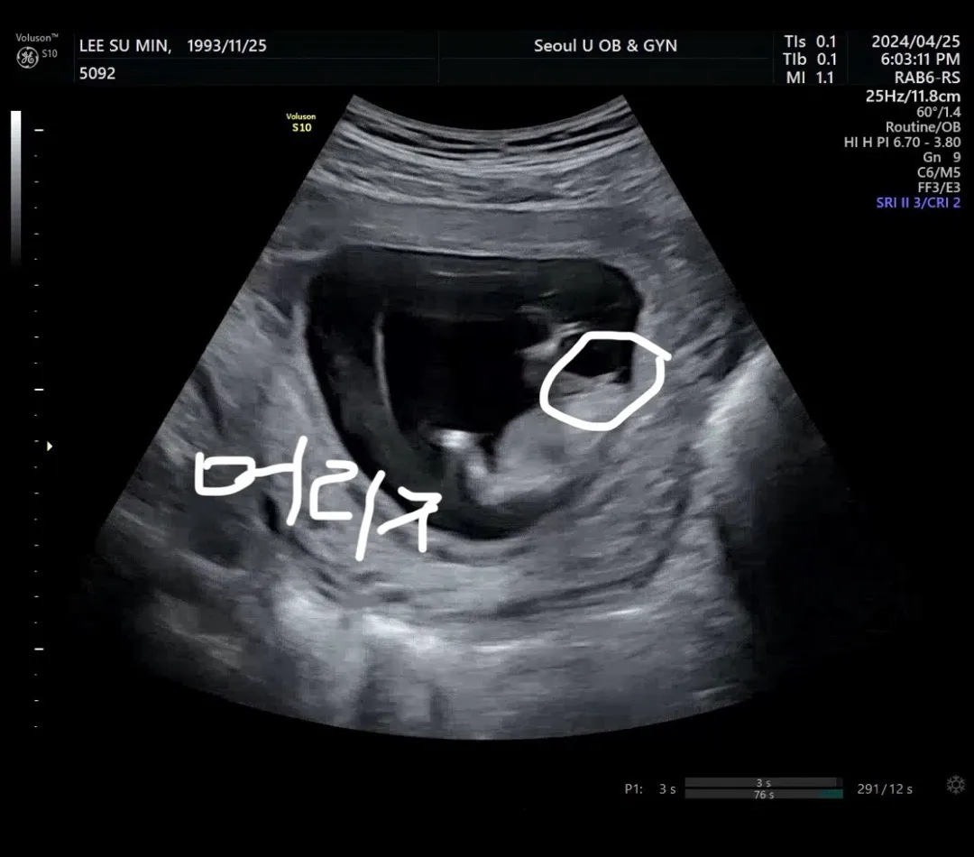 11주5일차 초음파