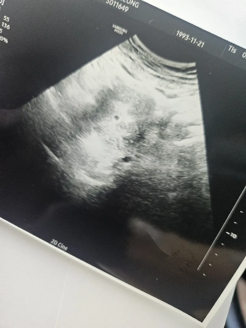 5주 초음파 아기집 크기
