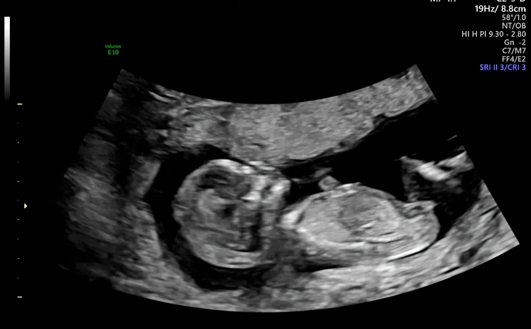 12주6일 아기 성별 봐주세요