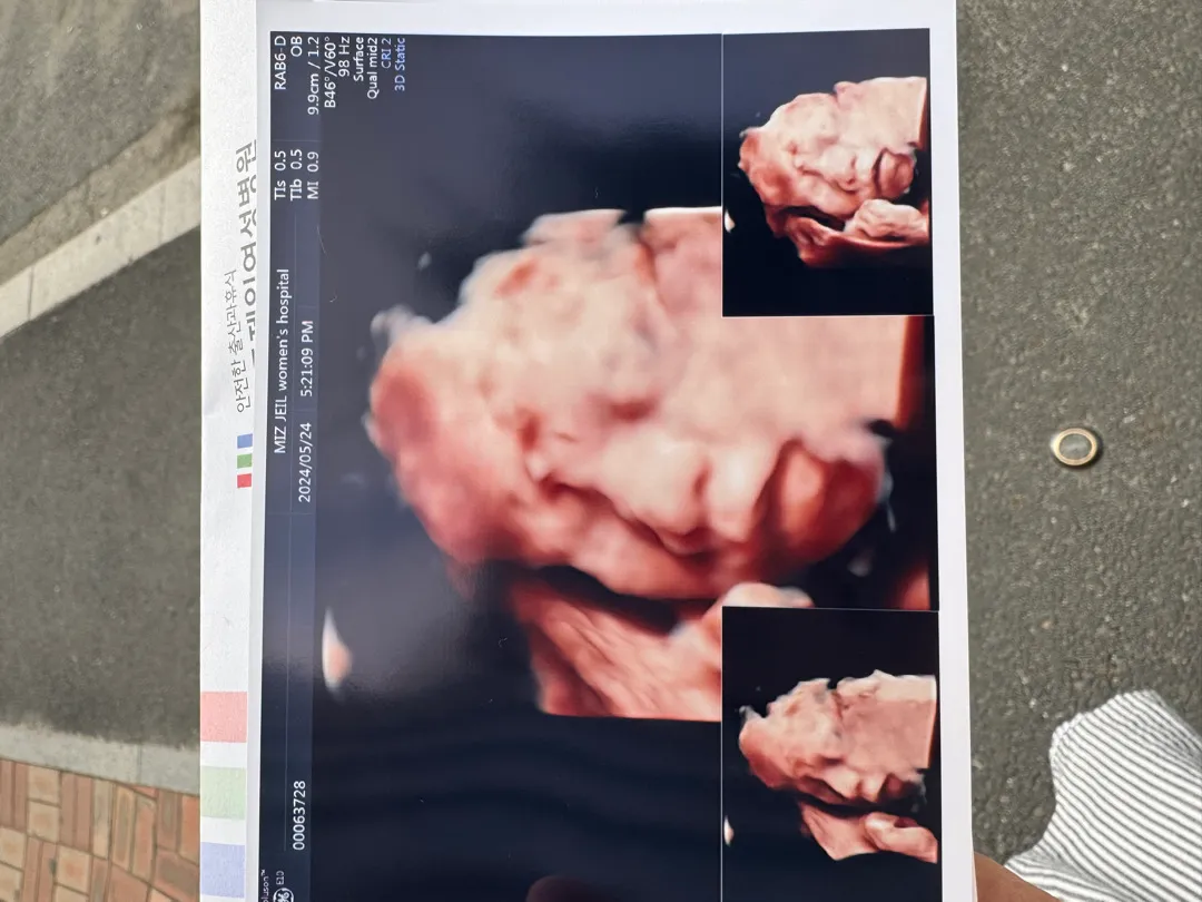 입체초음파
