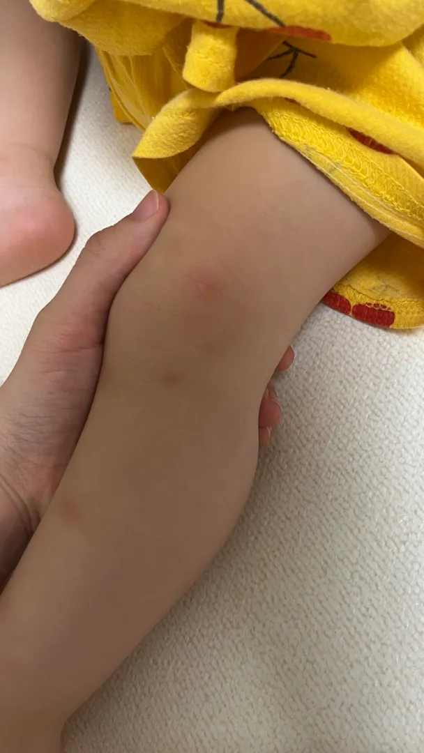 갑자기 쌀 알러지??