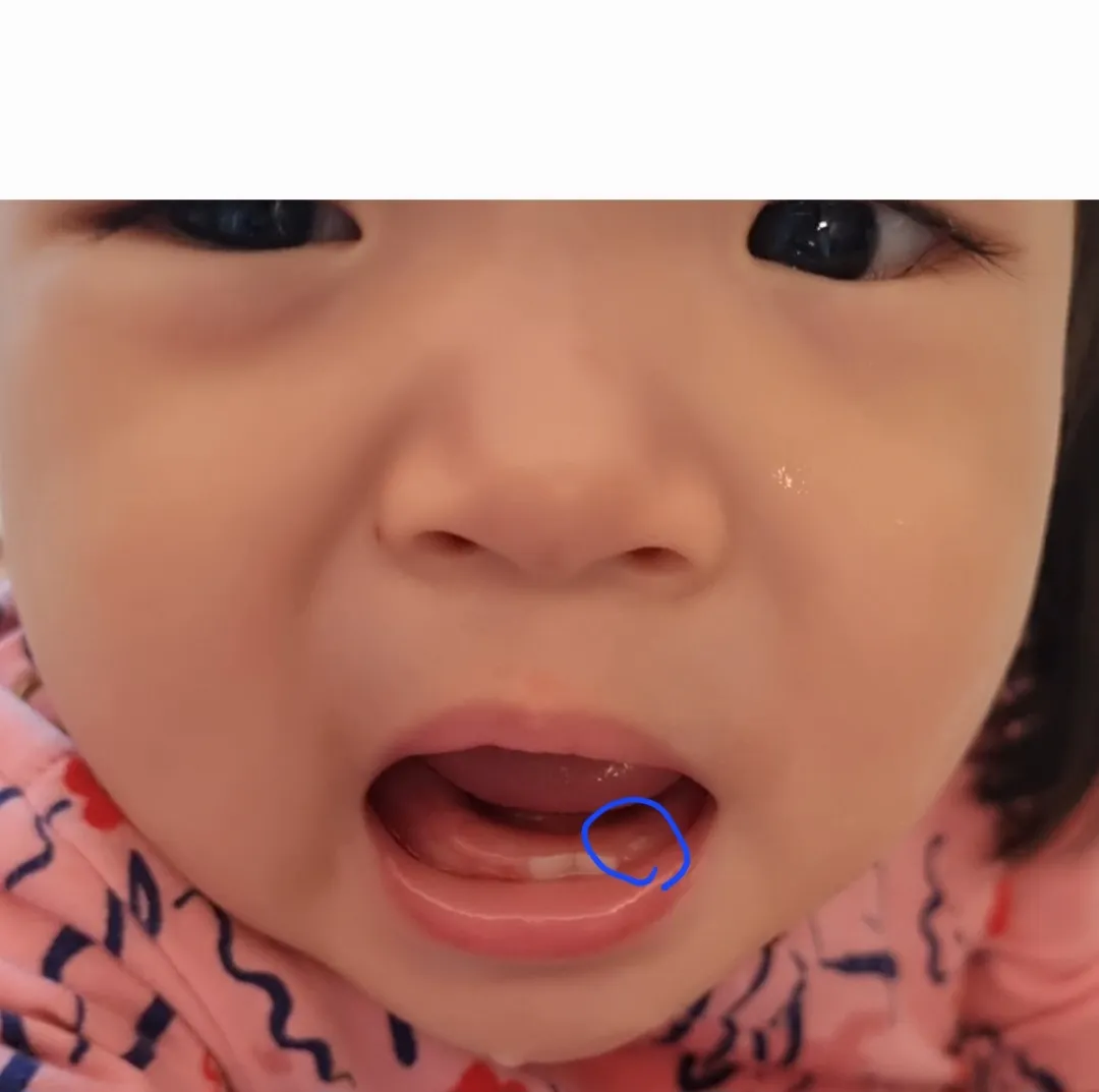 아기 아랫니