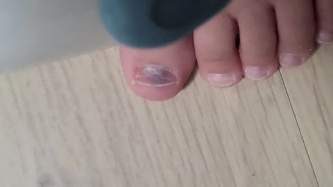 아기발가락