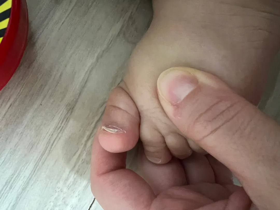 자꾸 찢어지는 아기 발톱때문에 고민이에요