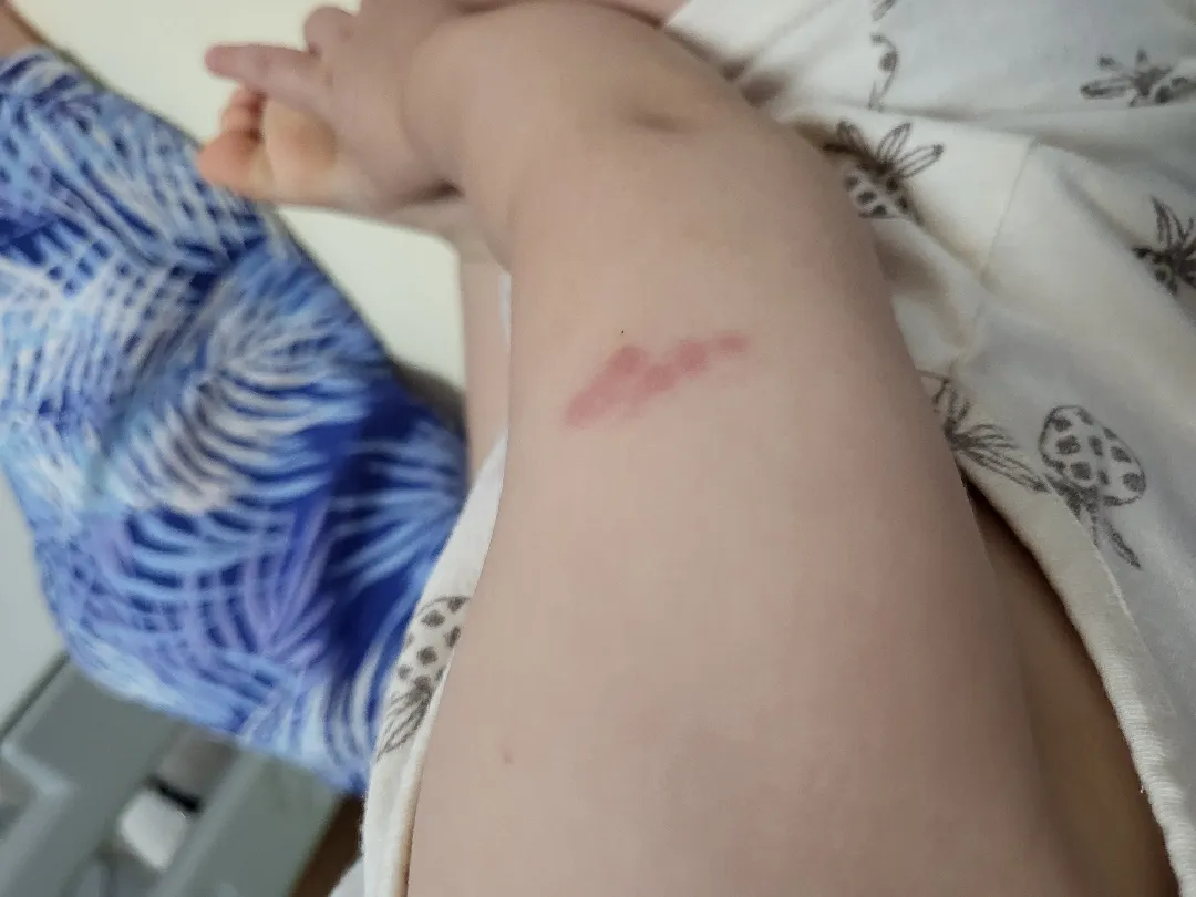 돌접종 주사부위요ㅠㅠ