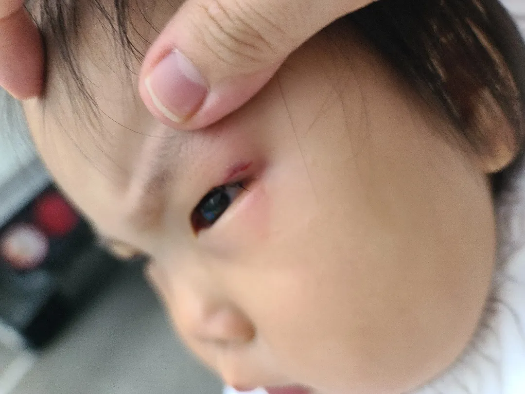 시소에서 떨어져서 눈을 다쳤어요ㅠ 어떡해야되죠?ㅠ