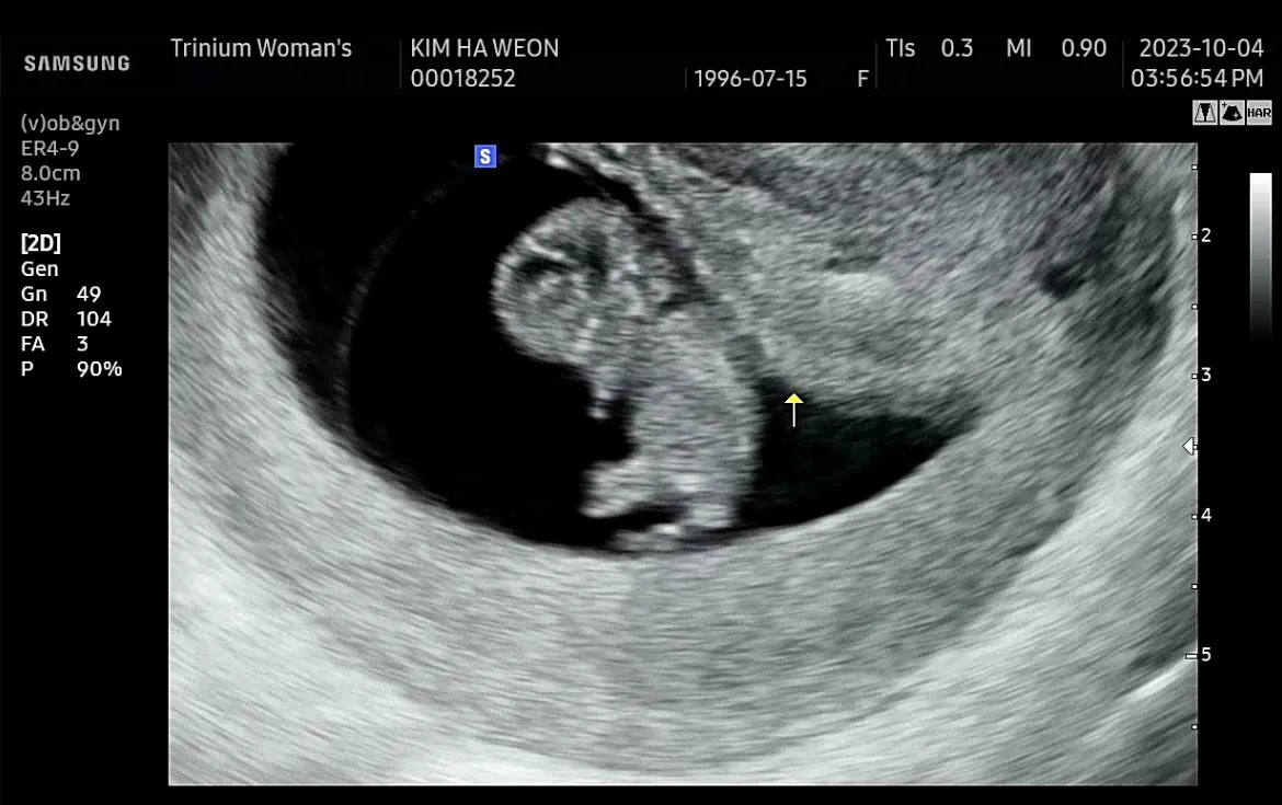 8주 5일 찰떡이보고왔어요!!