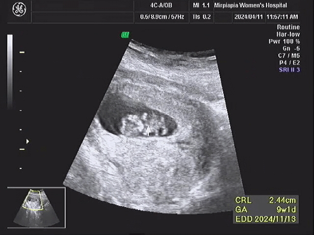 애기 움직이는거 보고 왔어요~~~ 9주1일차!
