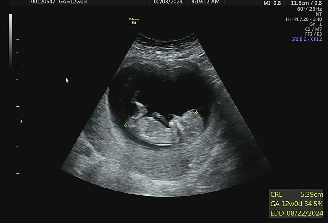 12주1일차 1차기형아검사하고왔어요