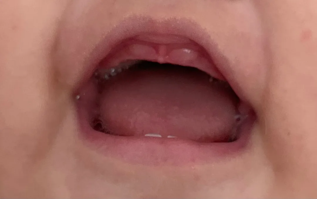 윗니 때문일까요? 