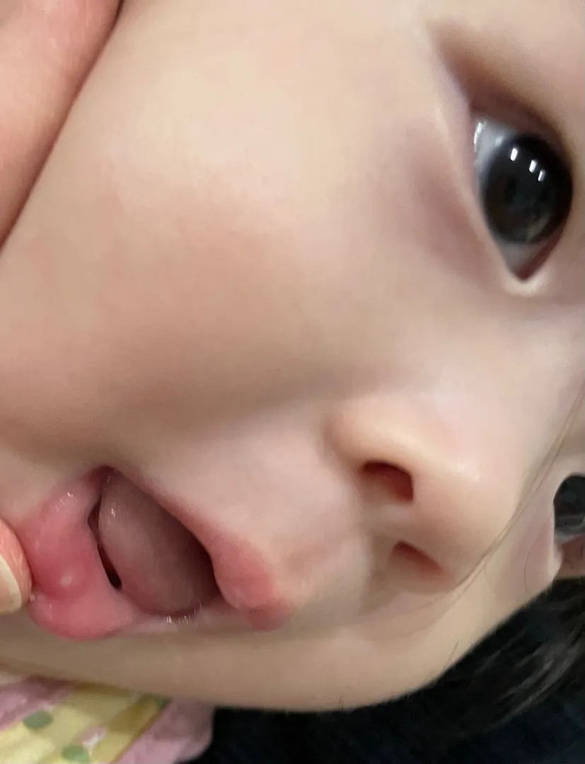 구내염일까요?ㅠㅠㅠ