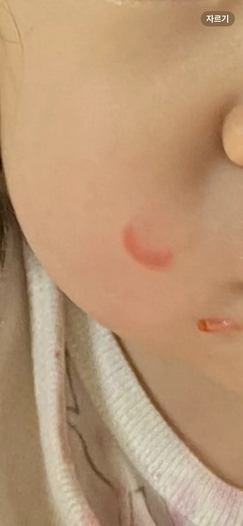 얼굴습진