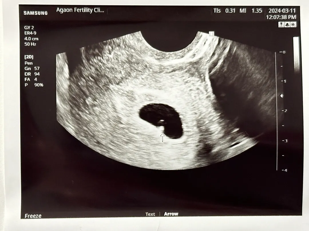 예상7w3d-> 5w3d 첨으로 아기 봤어요🥹