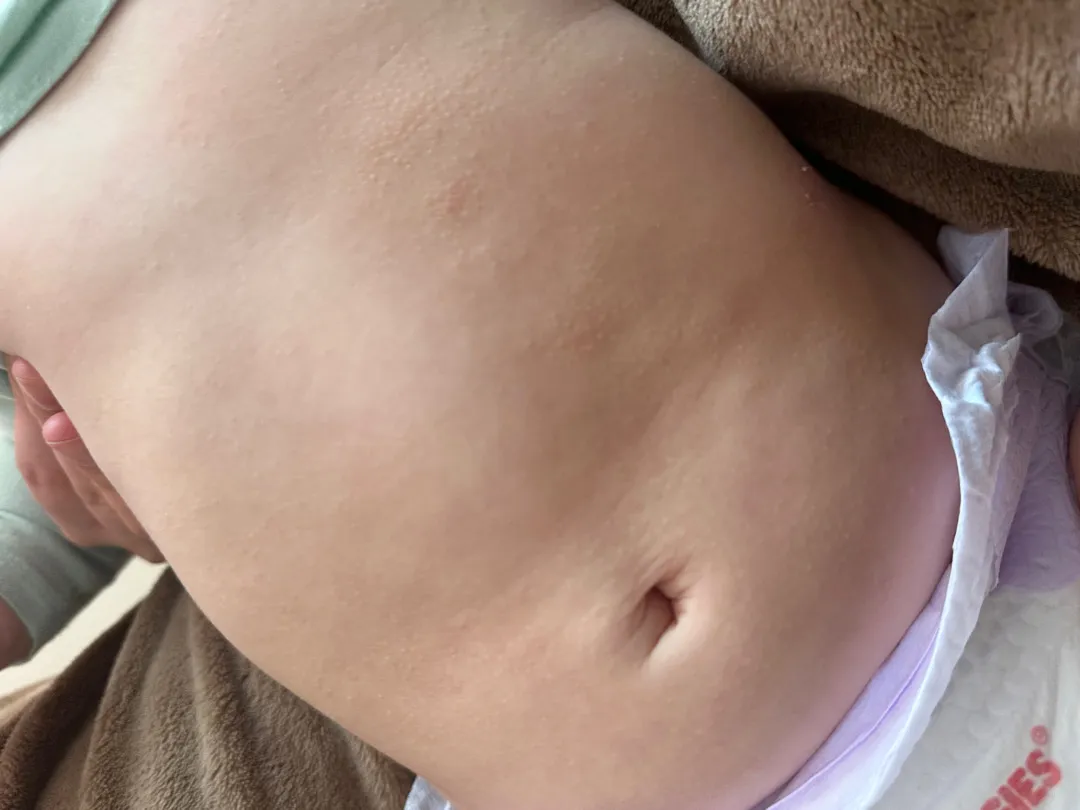 아기 피부가 갑자기 며칠전부터 아토피처럼 올라왔는데