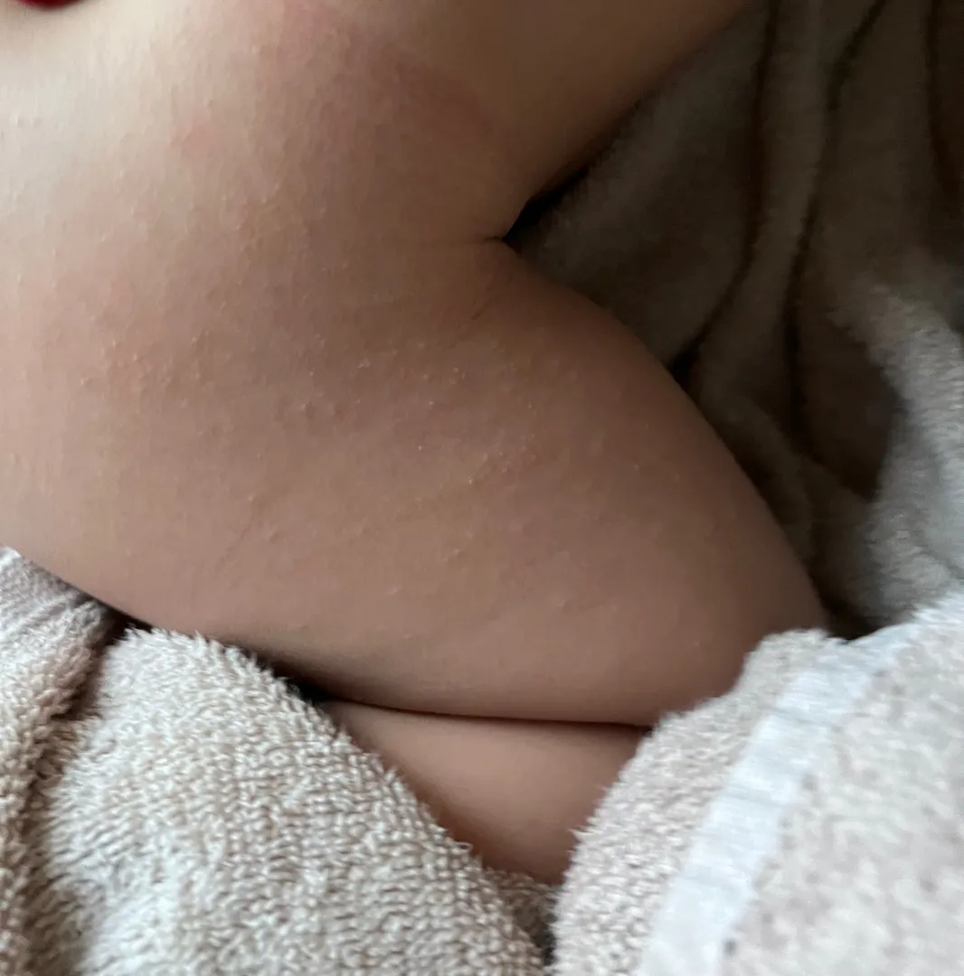 아기 피부 좀 봐주세요 ㅠㅠ