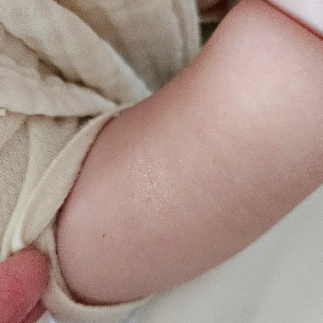 아기 피부 고민