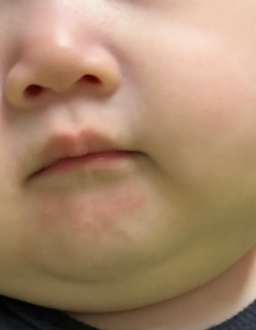 턱밑에 이건 침독이겠죠-?