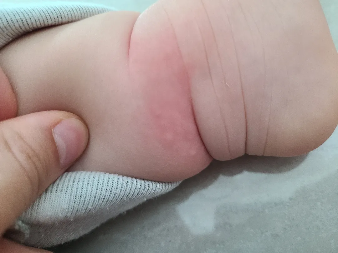 두드러기? 알러지? 같은게 올라왔다 없어졌다 해요