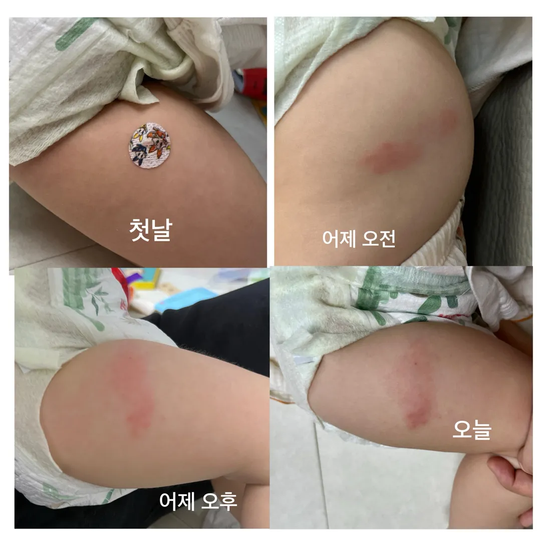 접종 후 부기, 발진?