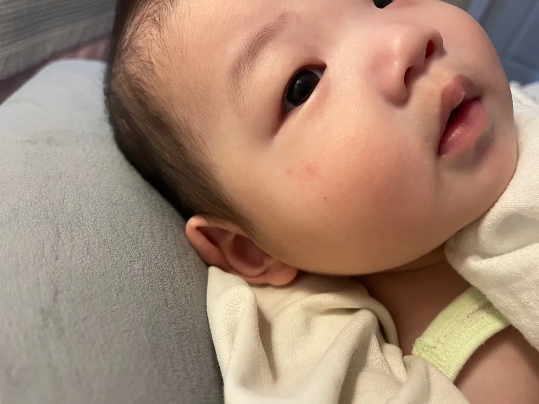 습진인거 같은데 비슷한 아기 있나요 ? 