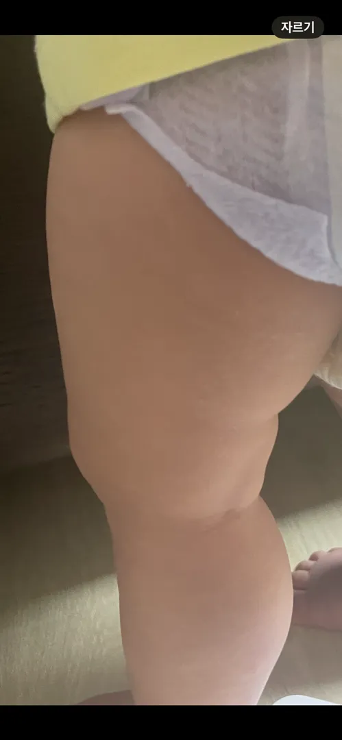 거칠거칠 아기 피부 ㅠㅠ