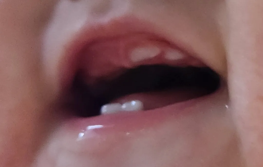 윗니가 다르게 나요ㅜㅜ