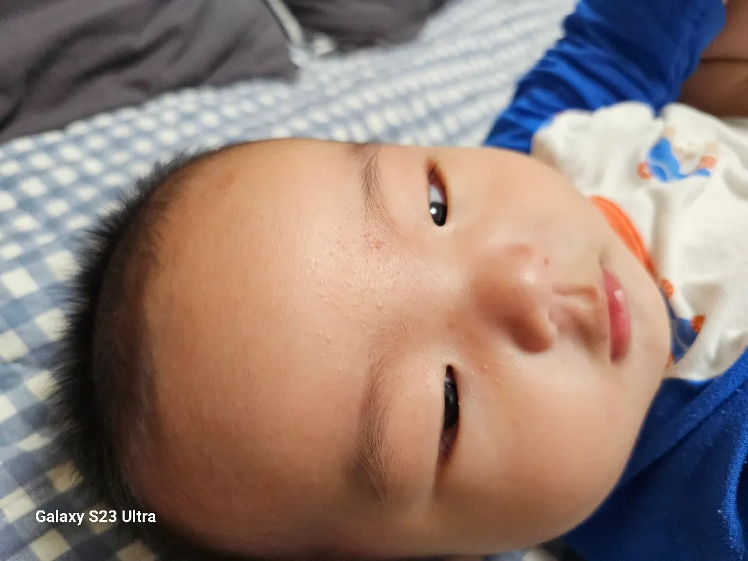 두드러기일까요?