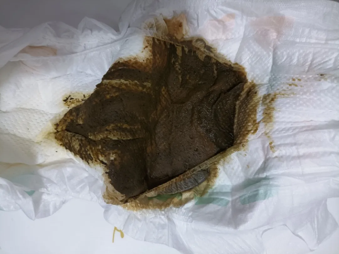 아기대변 사진있음