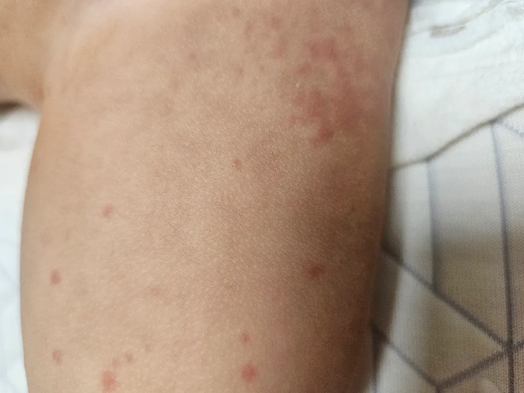 수족구인가요?