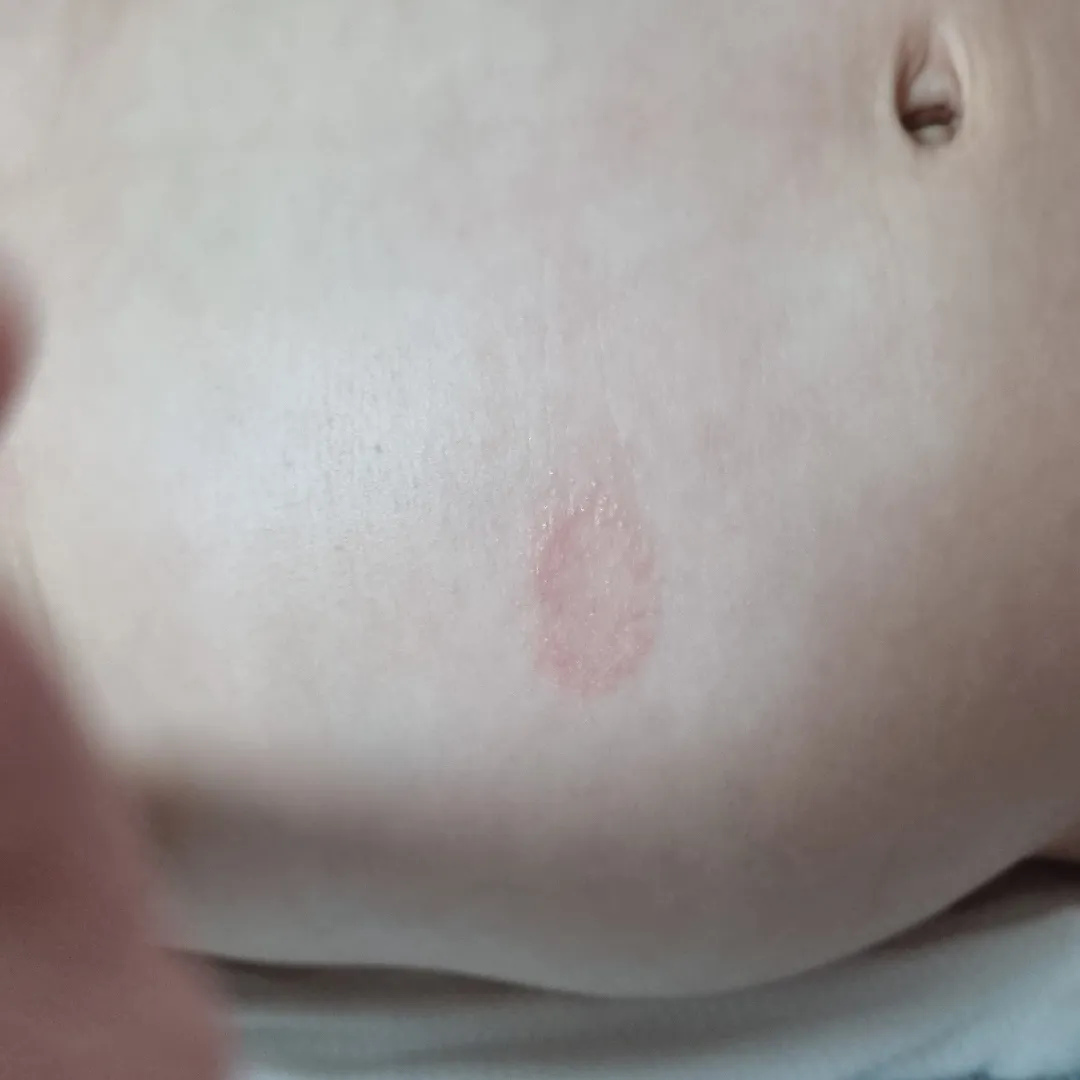 아기배에 두드러기처럼 올라왔어요ㅜ