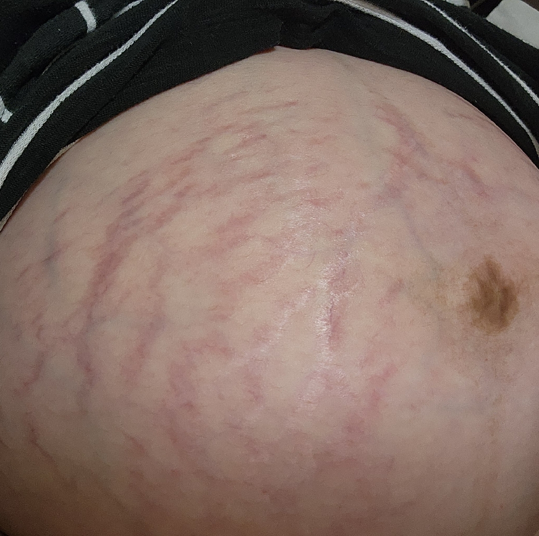 저처럼 튼살심하신분들 계신가요..ㅠㅠ