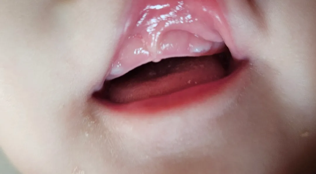 윗니 내려온 애기들 있나요?