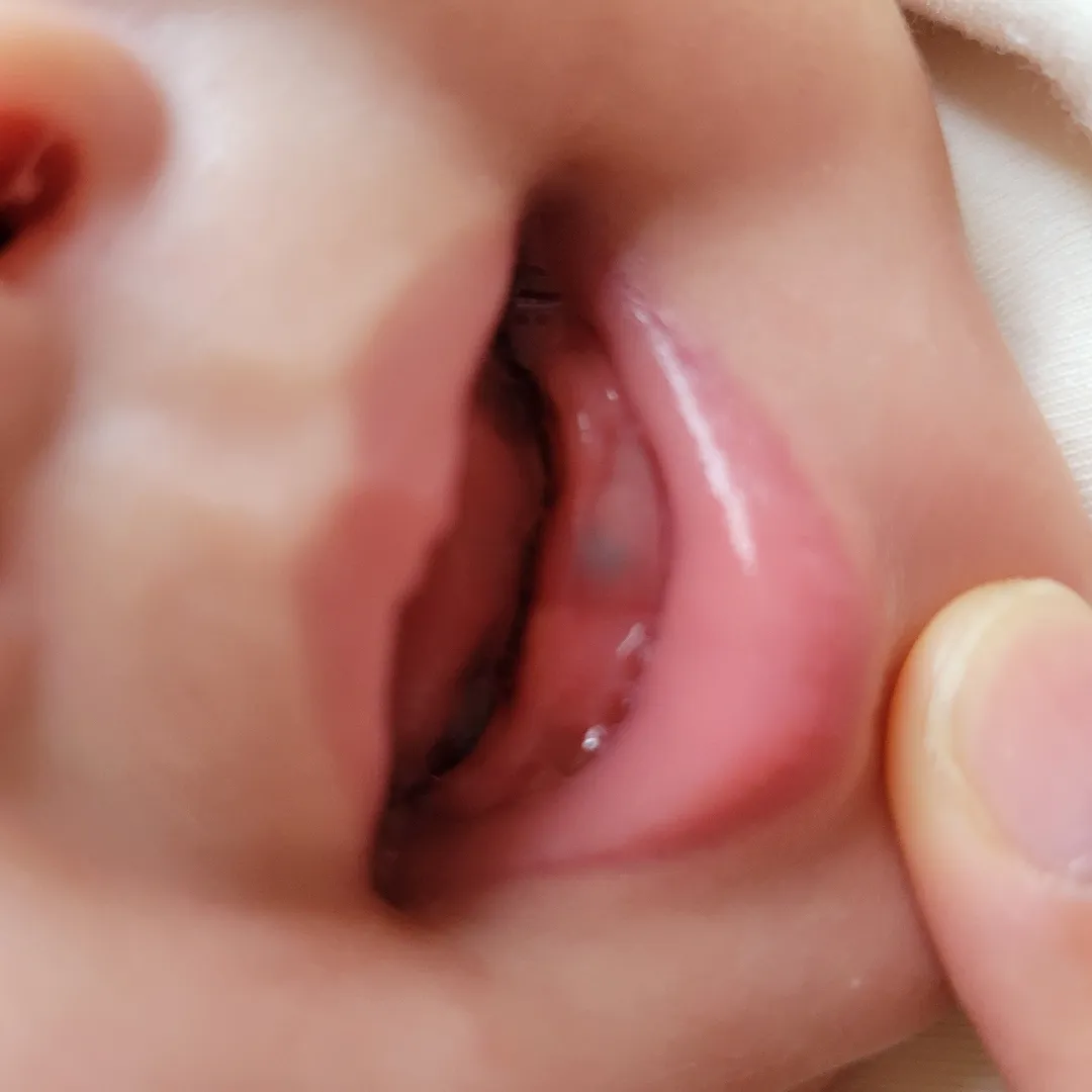 아기 앞니 나면서 잇몸 멍?피맺힘? 생긴 것 같아요.