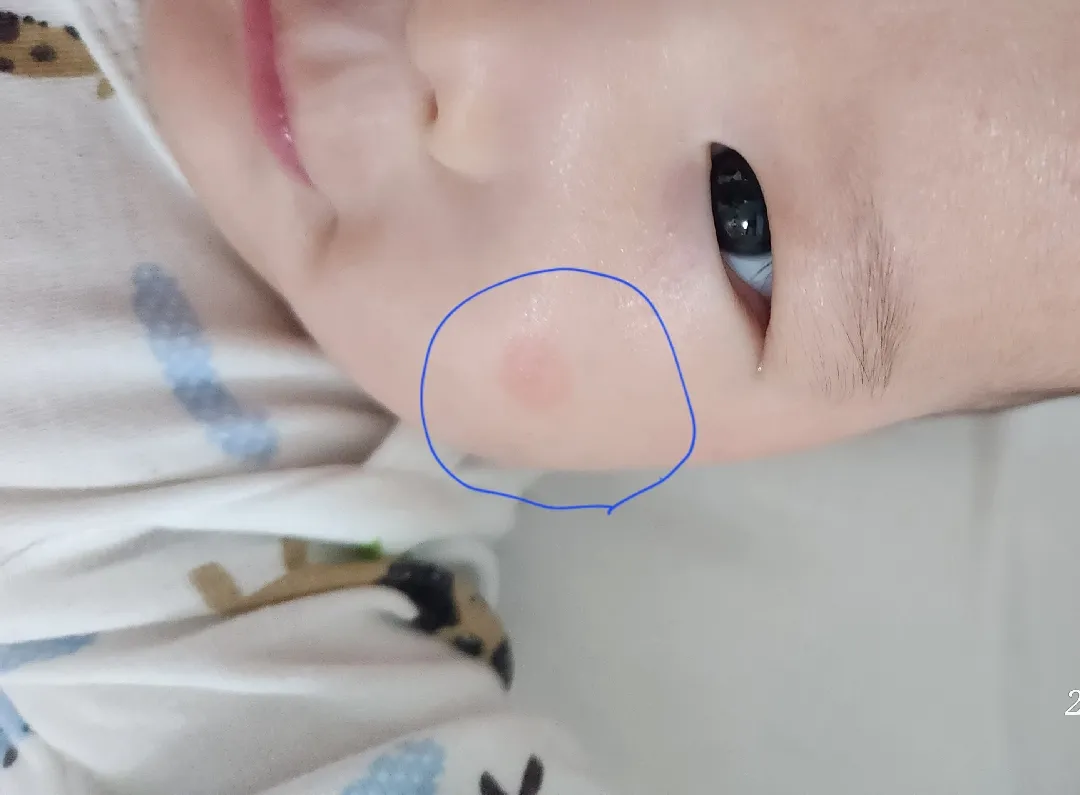 모기흉터