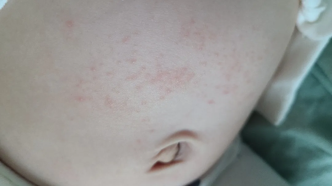 땀띠인가요?