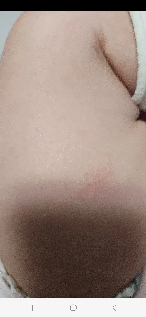 이거 혹시 아토피? 사진있어요. ㅠㅠ 