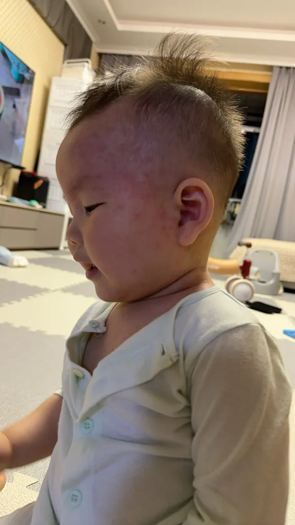 돌발진일가요?