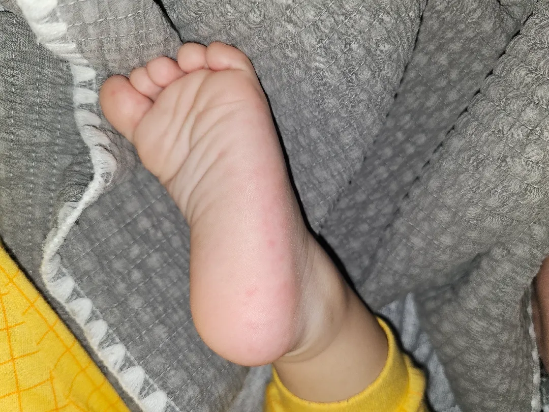 수족구일까요?