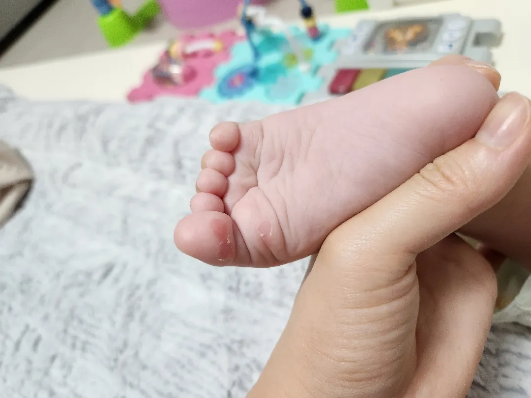 기어다니느라 발바닥이 자꾸 까져요ㅠㅠ