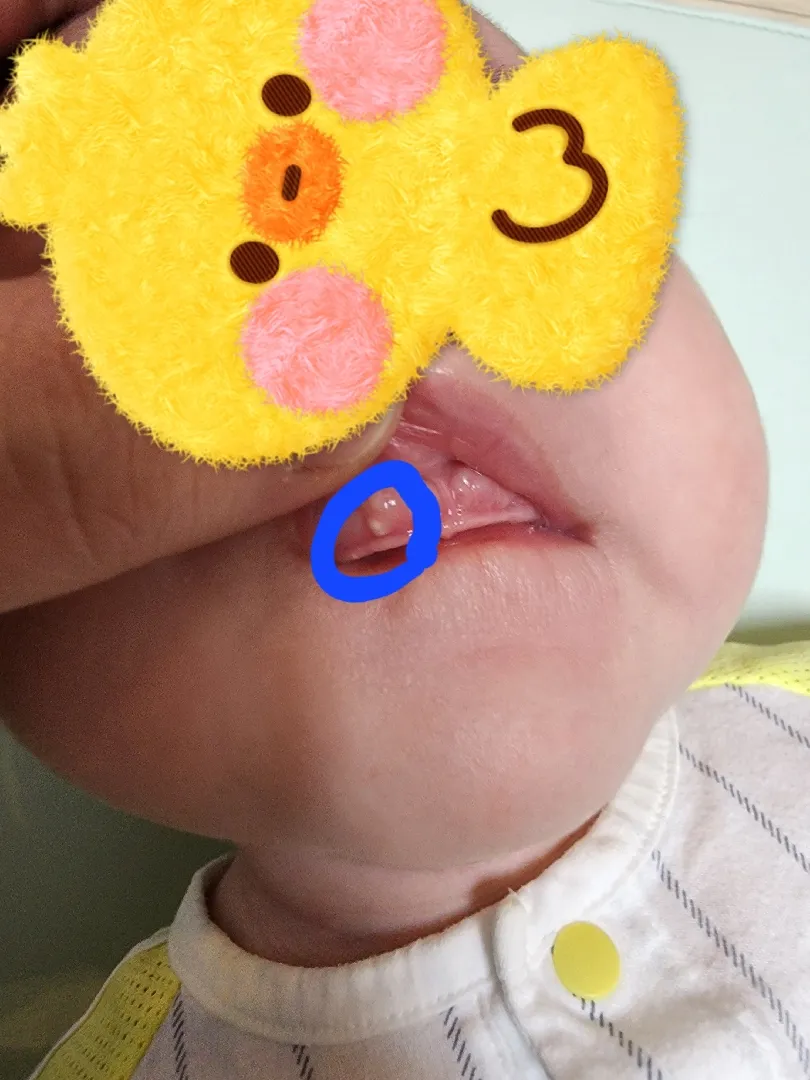 잇몸좀 봐주세요ㅠㅠ