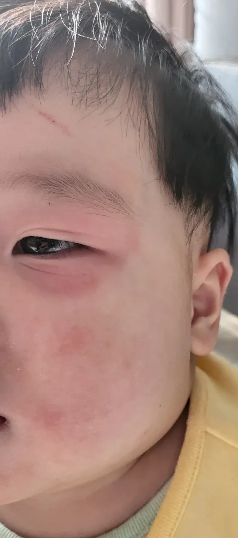 아기 얼굴 피부 문의