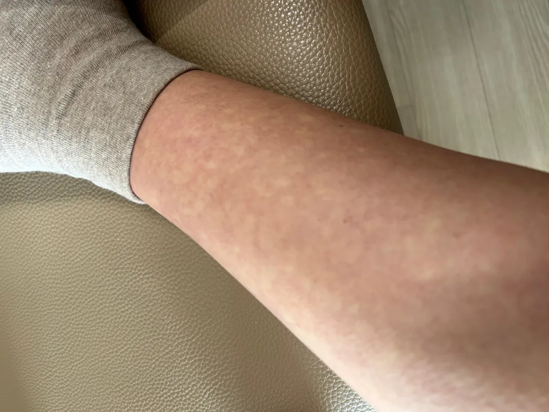 임신 29주 종아리 쪽 피부가 왜이렇죠ㅠ