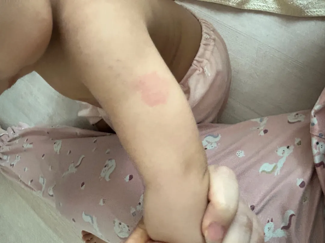 갑자기 생긴 빨간 반점? 상처?