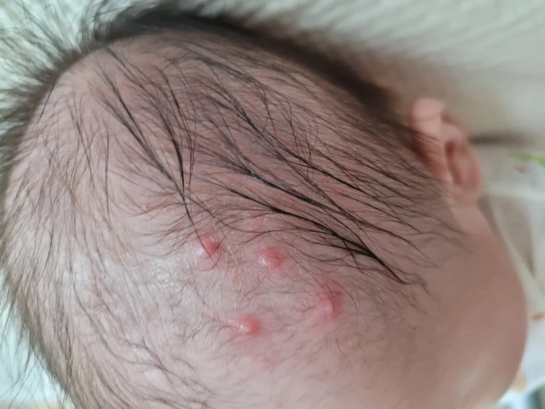 태열일까요? 모기물린 걸가요? (사진 있음)